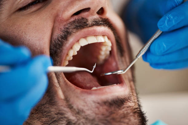 Best Emergency Dental Care for Broken or Chipped Teeth in Onalaska, TX
