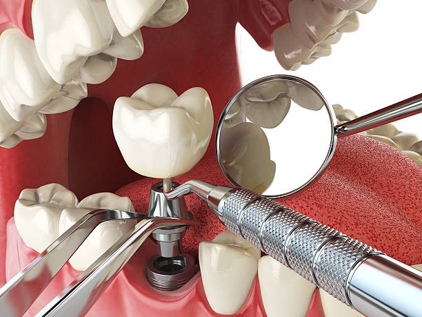 Best Emergency Treatment for Dental Infections or Abscesses in Onalaska, TX
