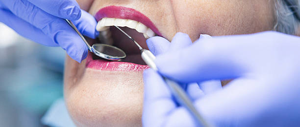 Best Emergency Wisdom Teeth Removal in Onalaska, TX